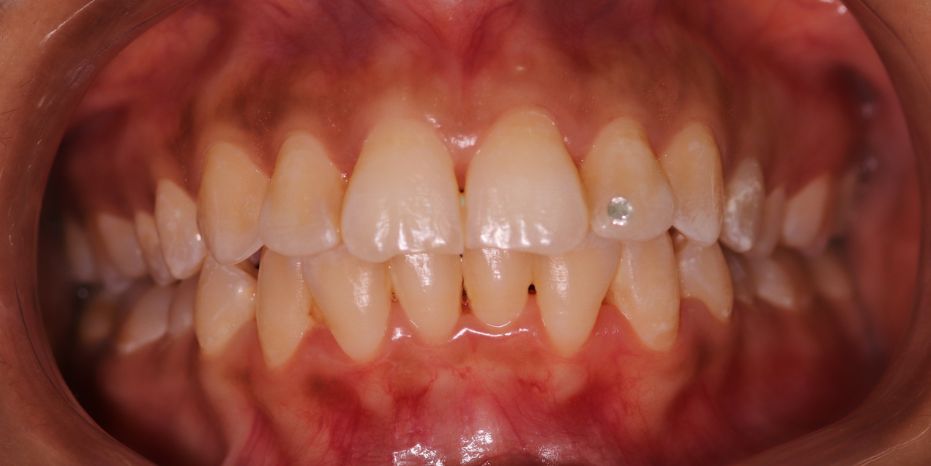 BLANQUEAMIENTO DENTAL   MURCIA